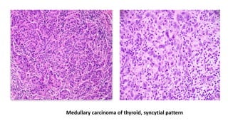 Medullary carcinoma of thyroid, syncytial pattern
 