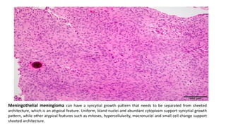 Meningothelial meningioma can have a syncytial growth pattern that needs to be separated from sheeted
architecture, which is an atypical feature. Uniform, bland nuclei and abundant cytoplasm support syncytial growth
pattern, while other atypical features such as mitoses, hypercellularity, macronuclei and small cell change support
sheeted architecture.
 