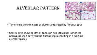 ALVEOLAR PATTERN
• Tumor cells grow in nests or clusters separated by fibrous septa
• Central cells showing loss of cohesion and individual tumor cell
necrosis is seen between the fibrous septa resulting in a lung like
alveolar spaces
 