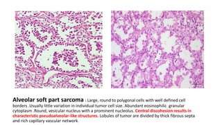 Alveolar soft part sarcoma : Large, round to polygonal cells with well defined cell
borders .Usually little variation in individual tumor cell size. Abundant eosinophilic granular
cytoplasm .Round, vesicular nucleus with a prominent nucleolus. Central discohesion results in
characteristic pseudoalveolar-like structures. Lobules of tumor are divided by thick fibrous septa
and rich capillary vascular network.
 