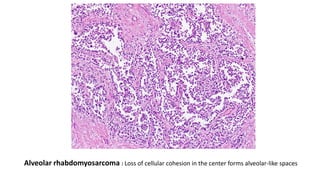 Alveolar rhabdomyosarcoma : Loss of cellular cohesion in the center forms alveolar-like spaces
 