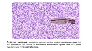 Synovial sarcoma: Monophasic synovial sarcoma showing sarcomatous areas that
are hypercellular and consist of monotonous fibroblast-like spindle cells with plump
nuclei arranged in intersecting fascicles.
 