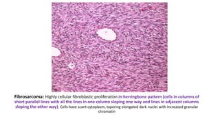 Fibrosarcoma: Highly cellular fibroblastic proliferation in herringbone pattern (cells in columns of
short parallel lines with all the lines in one column sloping one way and lines in adjacent columns
sloping the other way). Cells have scant cytoplasm, tapering elongated dark nuclei with increased granular
chromatin
 
