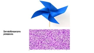 Dermatofibrosarcoma
protuberans
 