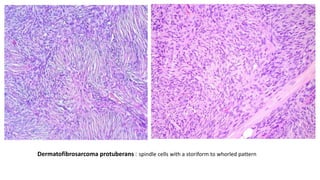 Dermatofibrosarcoma protuberans : spindle cells with a storiform to whorled pattern
 