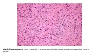Classic leiomyosarcoma: Tumor cells are set in long intersecting fascicles parallel and perpendicular to the plane of
section.
 