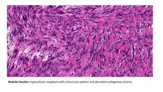 Nodular fasciitis: hypocellular neoplasm with a fascicular pattern and abundant collagenous stroma.
 