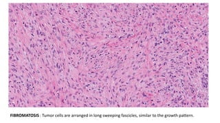 FIBROMATOSIS : Tumor cells are arranged in long sweeping fascicles, similar to the growth pattern.
 