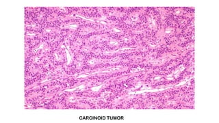 CARCINOID TUMOR
 