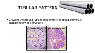 TUBULAR PATTERN
• Crowded small round tubules lined by single to multiple layers of
cuboidal to low columnar cells
 