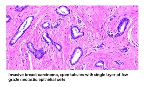 Invasive breast carcinoma, open tubules with single layer of low
grade neolastic epithelial cells
 