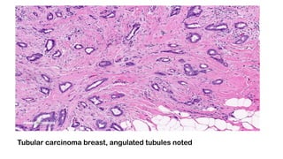 Tubular carcinoma breast, angulated tubules noted
 