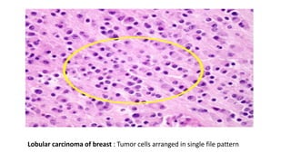 Lobular carcinoma of breast : Tumor cells arranged in single file pattern
 