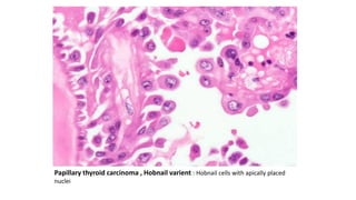 Papillary thyroid carcinoma , Hobnail varient : Hobnail cells with apically placed
nuclei
 
