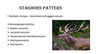 STAGHORN PATTERN
• Multiple sharply – branched and jagged vessels
Hemangiopericytoma
 Kaposi sarcoma
 synovial sarcoma
 mesenchymal chondrosarcoma
 leiomyosarcoma
 leiomyoma
 