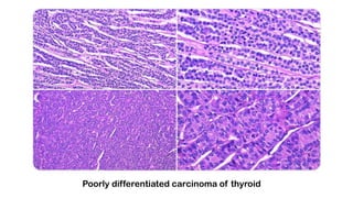 Poorly differentiated carcinoma of thyroid
 