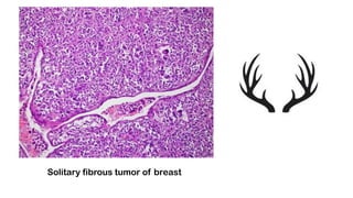 Solitary fibrous tumor of breast
 