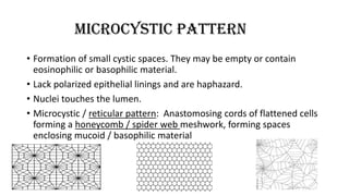 MICROCYSTIC PATTERN
• Formation of small cystic spaces. They may be empty or contain
eosinophilic or basophilic material.
• Lack polarized epithelial linings and are haphazard.
• Nuclei touches the lumen.
• Microcystic / reticular pattern: Anastomosing cords of flattened cells
forming a honeycomb / spider web meshwork, forming spaces
enclosing mucoid / basophilic material
 