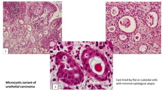 Cyst lined by flat or cuboidal cells
with minimal cytological atypia
Microcystic variant of
urothelial carcinoma
 