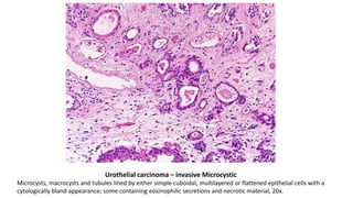 Urothelial carcinoma – invasive Microcystic
Microcysts, macrocysts and tubules lined by either simple cuboidal, multilayered or flattened epithelial cells with a
cytologically bland appearance; some containing eosinophilic secretions and necrotic material, 20x.
 