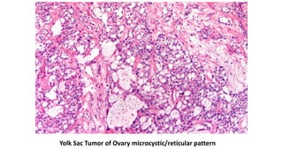 Yolk Sac Tumor of Ovary microcystic/reticular pattern
 