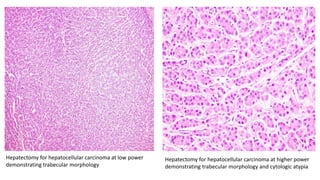 Hepatectomy for hepatocellular carcinoma at low power
demonstrating trabecular morphology
Hepatectomy for hepatocellular carcinoma at higher power
demonstrating trabecular morphology and cytologic atypia
 