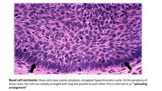 Basal cell carcinoma: these cells have scanty cytoplasm, elongated hyperchromatic nuclei. At the periphery of
these nests, the cells are radially arranged with long axis parallel to each other. This is referred to as “ palisading
arrangement”
 