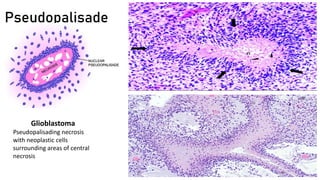 Pseudopalisade
Glioblastoma
Pseudopalisading necrosis
with neoplastic cells
surrounding areas of central
necrosis
 