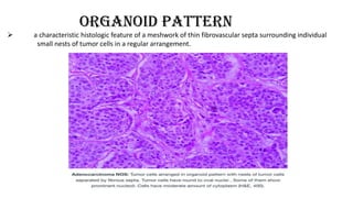 ORGANOID PATTERN
 a characteristic histologic feature of a meshwork of thin fibrovascular septa surrounding individual
small nests of tumor cells in a regular arrangement.
 