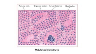 Medullary carcinoma thyroid
 