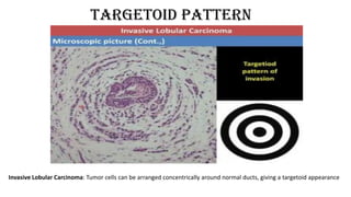 Targetoid pattern
Invasive Lobular Carcinoma: Tumor cells can be arranged concentrically around normal ducts, giving a targetoid appearance
 