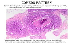Comedo pattern
Ductal carcinoma in situ : Intermediate power view of an intraductal epithelial proliferation with
intermediate grade nuclear atypia, cribriform growth pattern, comedo necrosis and microcalcifications.
Comedo : Central expansile necrosis containing cellular debris, generally associated with high grade DCIS,
frequently associated with coarse microcalcifications
 