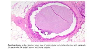 Ductal carcinoma in situ : Medium power view of an intraductal epithelial proliferation with high grade
nuclear atypia , flat growth pattern and central necrosis.
 