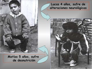 Lucas 4 años, sufre de
alteraciones neurológicas
Matías 5 años, sufre
de desnutrición
 