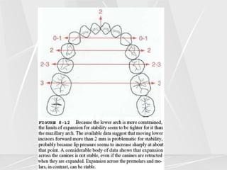 Arch lengthening and expansion.ppt