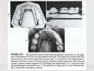 Arch lengthening and expansion.ppt