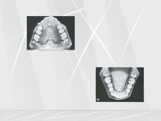 Arch lengthening and expansion.ppt