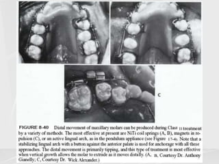 Arch lengthening and expansion.ppt