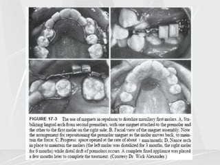 Arch lengthening and expansion.ppt