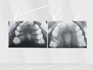 Arch lengthening and expansion.ppt
