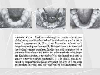 Arch lengthening and expansion.ppt