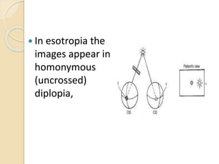  In esotropia the
images appear in
homonymous
(uncrossed)
diplopia,
 