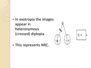  In exotropia the images
appear in
heteronymous
(crossed) diplopia
 This represents NRC.
 