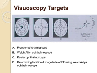 Visuoscopy Targets
A. Propper ophthalmoscope
B. Welch-Allyn ophthalmoscope
C. Keeler ophthalmoscope
D. Determining location & magnitude of EF using Welch-Allyn
ophthalmoscope
 