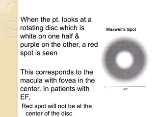 When the pt. looks at a
rotating disc which is
white on one half &
purple on the other, a red
spot is seen
This corresponds to the
macula with fovea in the
center. In patients with
EF,
Red spot will not be at the
center of the disc
 