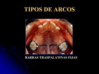 Que Es El Arco Transpalatino En Ortodoncia PPT que-es-el-arco-transpalatino-en-ortodoncia-ppt