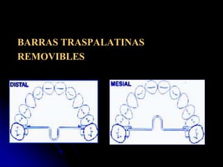 Que Es El Arco Transpalatino En Ortodoncia PPT que-es-el-arco-transpalatino-en-ortodoncia-ppt