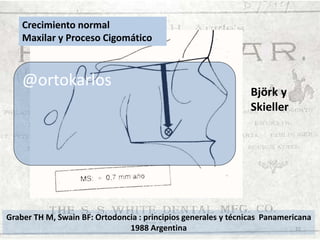 Crecimiento normal
Maxilar y Proceso Cigomático

@ortokarlos

Björk y
Skieller

Graber TH M, Swain BF: Ortodoncia : principios generales y técnicas Panamericana
1988 Argentina
22

 