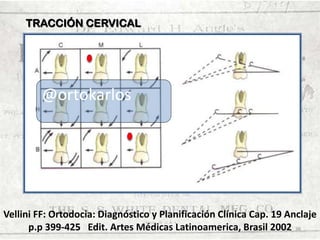 TRACCIÓN CERVICAL

@ortokarlos

Vellini FF: Ortodocia: Diagnóstico y Planificación Clínica Cap. 19 Anclaje
p.p 399-425 Edit. Artes Médicas Latinoamerica, Brasil 2002 38

 