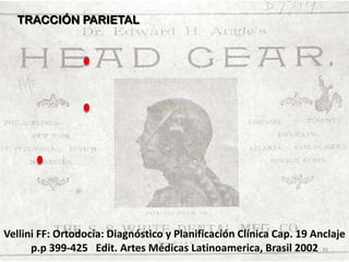 TRACCIÓN PARIETAL

Vellini FF: Ortodocia: Diagnóstico y Planificación Clínica Cap. 19 Anclaje
p.p 399-425 Edit. Artes Médicas Latinoamerica, Brasil 2002 39

 